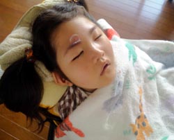 蚊に刺されました